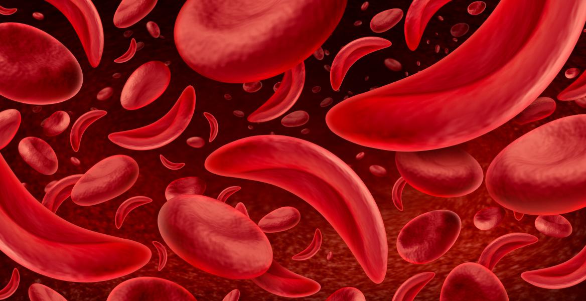 A picture of red blood cells in someone who has sickle cell disease